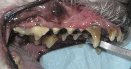上顎の歯石 (1)