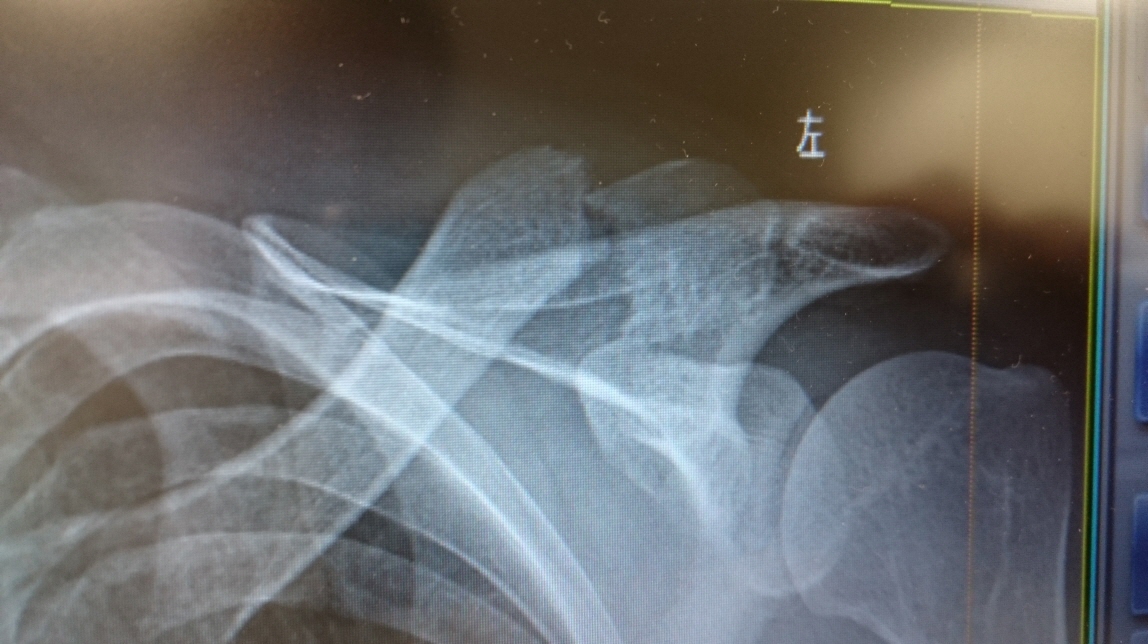 clavicle　fracture