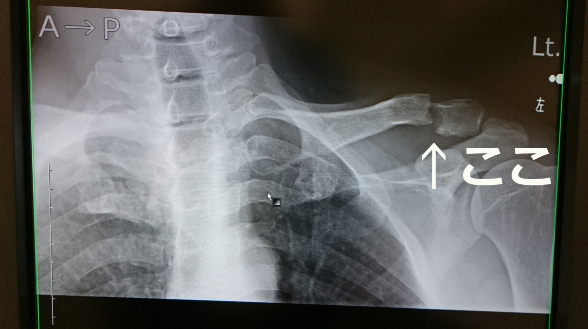 clavicle　fracture